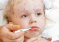 Ministerul Sănătății a declarat epidemie de rujeolă în Românie!