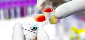 Nou site dedicat comunității de hemofilie din România