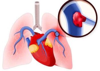 Lecția de la Babeș: Trombembolismul Pulmonar