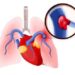 Lecția de la Babeș: Trombembolismul Pulmonar