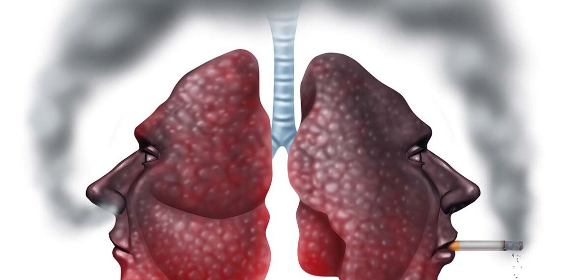 Azi este Ziua Mondială de Luptă Împotriva BPOC, boala tăcută care ucide mii de români anual