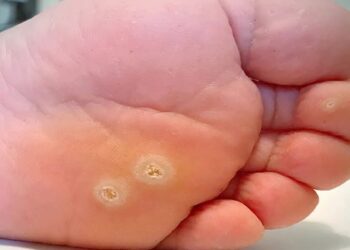 Verucile plantare – cum apar și cum se tratează