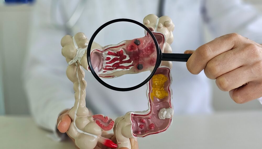 Cancerul colorectal, o problemă majoră de sănătate publică. Screening gratuit la Spitalul „Victor Babeș” Timișoara