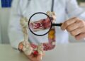 Cancerul colorectal, o problemă majoră de sănătate publică. Screening gratuit la Spitalul „Victor Babeș” Timișoara