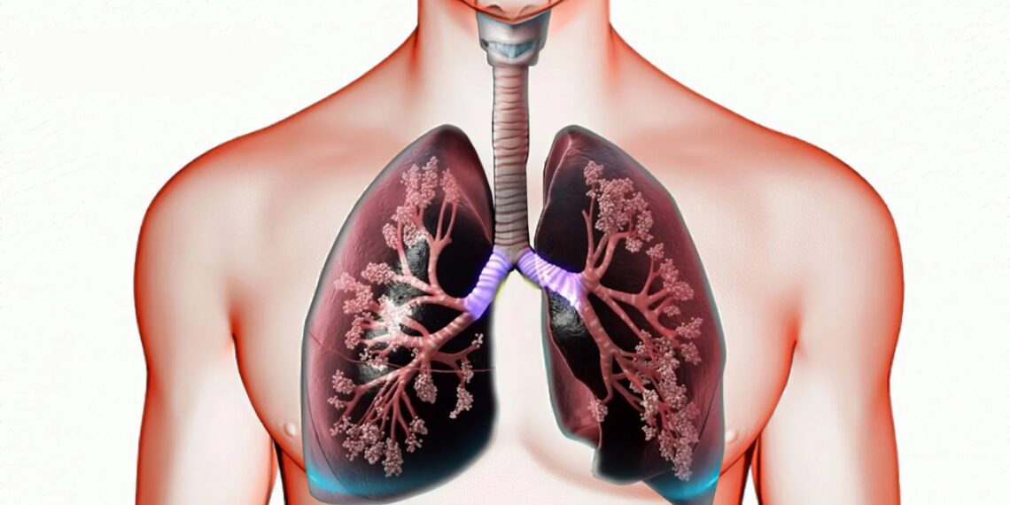 Emfizemul pulmonar: când plămânii nu mai pot elimina aerul corect