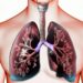 Emfizemul pulmonar: când plămânii nu mai pot elimina aerul corect