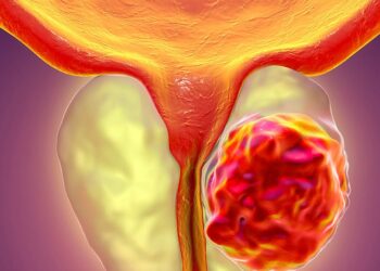Medicii trag un semnal de alarmă de Ziua Mondială de Luptă Împotriva Cancerului de Prostată: „Un simplu test PSA poate salva vieți”