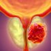 Medicii trag un semnal de alarmă de Ziua Mondială de Luptă Împotriva Cancerului de Prostată: „Un simplu test PSA poate salva vieți”