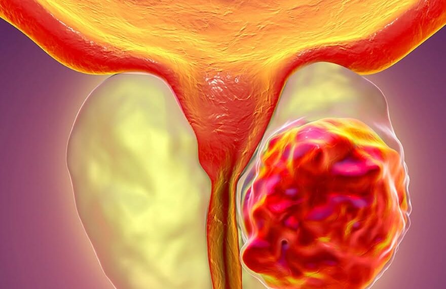 Medicii trag un semnal de alarmă de Ziua Mondială de Luptă Împotriva Cancerului de Prostată: „Un simplu test PSA poate salva vieți”